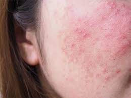 Hautprobleme im Gesicht: Ursachen, Behandlung und Pflegetipps für eine gesunde Haut